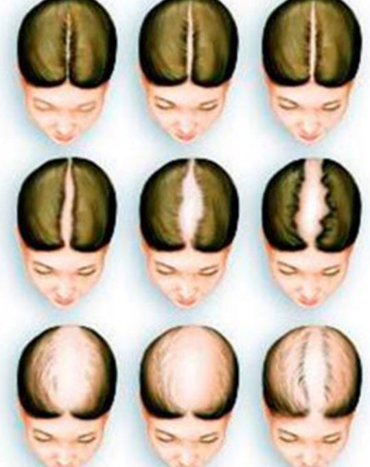 Androgenetische Alopezie: Ursachen und Merkmale