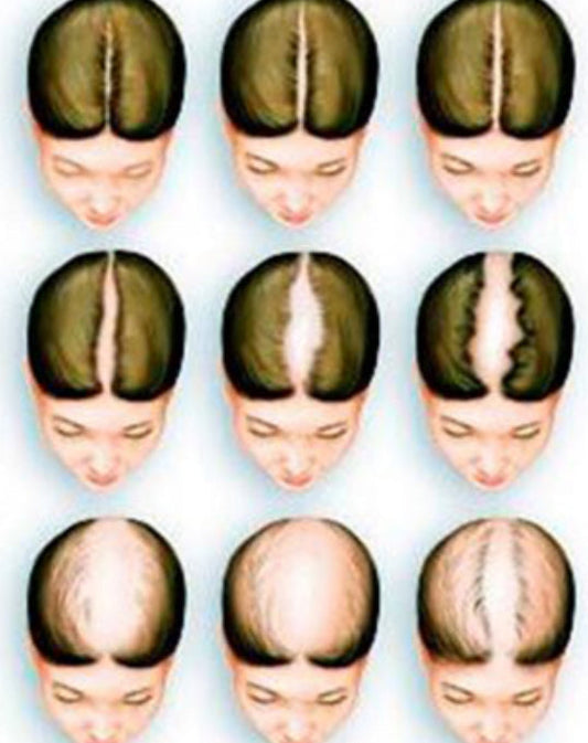 Androgenetische Alopezie: Ursachen und Merkmale