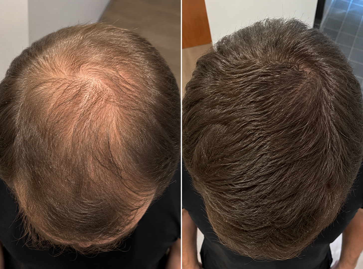 Vorher Nachher Ergebnis eines Mannes mit genetischer Alopezie und sichtbar dichterem Haar nach Behandlung gegen Haarausfall